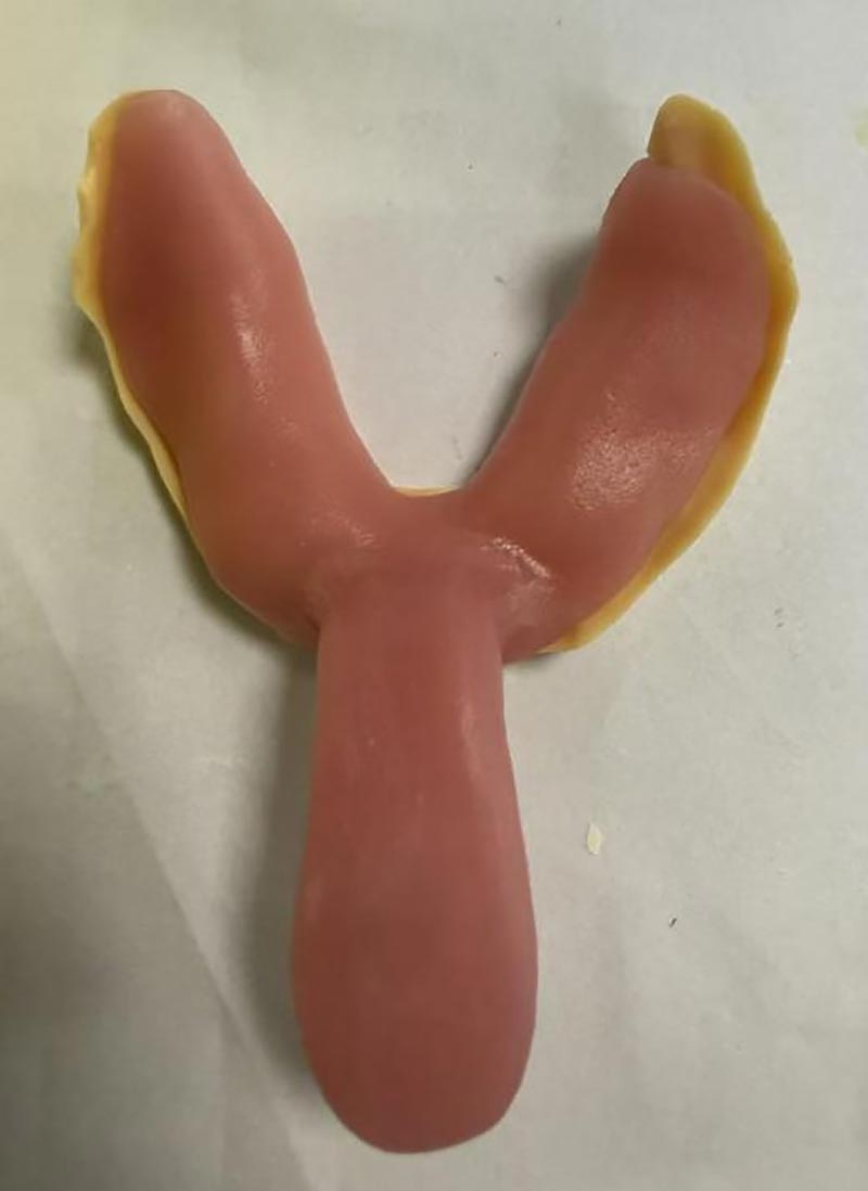 Πράγματα που δεν ξέρατε για τους προσαρμοσμένους οδοντιατρικούς δίσκους