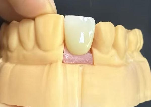 Τα κενά μεταξύ των δοντιών μπορούν να διορθωθούν—Τα ίσια δόντια είναι τα πιο ελκυστικά!