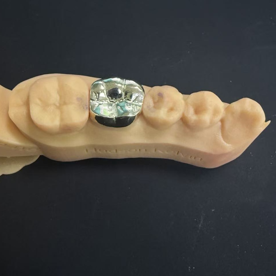 Χρυσές κορώνες: Η επιλογή πολύτιμων μετάλλων για ισόβια οδοντική αποκατάσταση