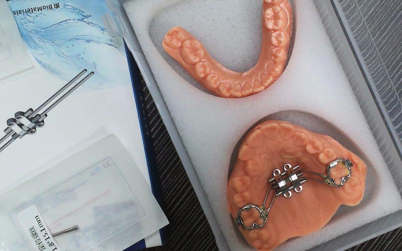 Κατανοήστε το MSE Skeletal Expansion με το WM Dental Lab