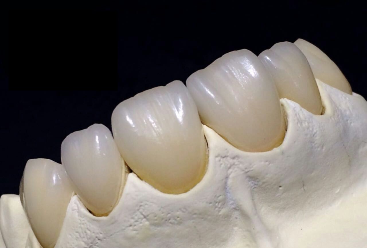 Full Zirconia Crown China οδοντιατρικό εργαστήριο