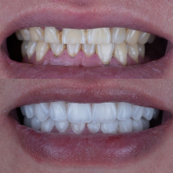 Emax Layered Veneers Esthetic China Dental Lab εργασίας