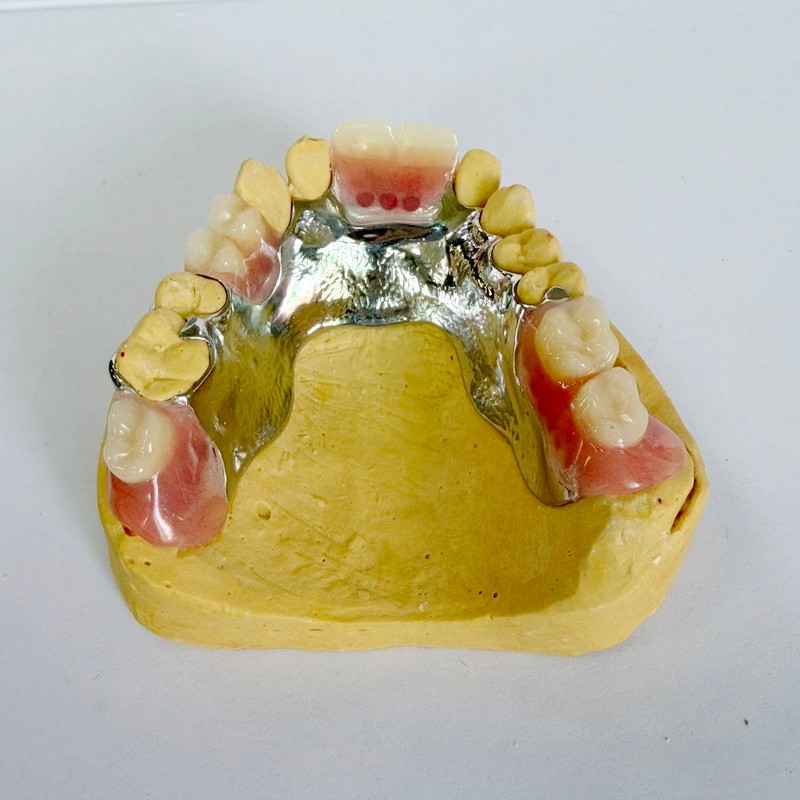 Αφαιρούμενο Μερικό Πλαίσιο Αποκατάστασης